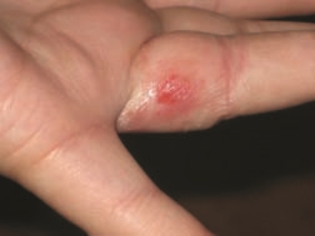 This figure shows a skin reaction that developed as the result of the reaction of the individual to a ring that was not pure gold but was alloyed with nickel. The reaction appeared 2 days after wearing the ring. This rash is    A) pemphigus vulgaris. B) It is an IgE-mediated reaction C) It is a type III hypersensitivity. reaction. D) It is a type IV hypersensitivity reaction. E) A and D