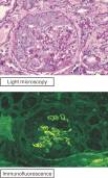 The figure shows routine histologic and immunofluorescence images of a kidney biopsy specimen taken from a 53-year-old man with acute-onset renal failure and hemoptysis (coughing up blood) .The histologic section is notable for glomerular inflammation in a crescentic distribution.Staining,using fluorescently tagged anti-IgG antibody,shows linear deposits of IgG along the glomerular basement membrane.Urinalysis is positive for moderate proteinuria and red cell casts.A chest radiograph shows pulmonary infiltrates.Which of the following is the most likely diagnosis?   A) Systemic lupus erythematosus B) Graves' disease C) Chronic allograft rejection D) Goodpasture's syndrome E) Poststreptococcal glomerulonephritis 