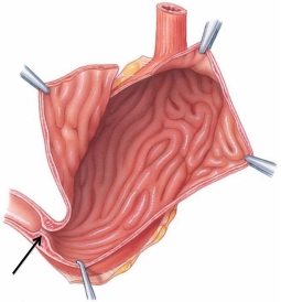 Identify the structure at the tip of the arrow in the following figure.   A)  pyloric sphincter B)  lower esophageal sphincter C)  ileocecal sphincter D)  anal sphincter