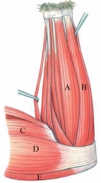 Identify the muscle labeled  A  in the following figure.   A)  palmaris longus B)  flexor carpi ulnaris C)  biceps brachii D)  epitrochlearis E)  triceps brachii