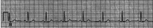 A patient presents for her annual physical examination in seemingly good health.However,she is concerned about her heart because of family history,and you proceed to work up an examination of cardiovascular function.She has a blood pressure of 128/83 mm Hg,and echocardiography indicates that end-diastolic volume is 140 mL and end-systolic volume is 80 mL.A routine ECG is obtained and is shown as follows:   Inspection of the ECG indicates a PR interval of: A) 0.08 seconds B) 0.10 seconds C) 0.12 seconds D) 0.16 seconds E) 0.20 seconds