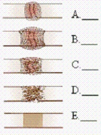 Match the normal sequence of bone healing shown in the figures below with the list of stages.   Stages: Callus formation<div style=padding-top: 35px> 