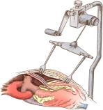 In looking at the illustration below,which option most accurately defines its primary function?   A)  Exposes the internal mammary artery and facilitates dissection. B)  Exposes the aortic arch for cannulation. C)  Exposes the SVC and RA for cannulation. D)  Exposes the anterolateral coronary arteries for graft anastamosis.