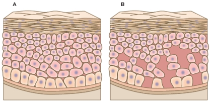 Refer to the figures below.   Figure A shows a cross section through normal human skin.Figure B shows a cross section through skin of an individual with a disorder that disrupts linkages between proteins in desmosomes.This disorder causes severe blistering of the skin.What does this disorder indicate about the role of cell junctions in human skin? A)  Desmosomes regulate skin cell development. B)  Desmosomes maintain the continuity of skin tissue. C)  Desmosomes increase the migration of cells within skin tissue. D)  Desmosomes maintain internal structures within skin cells. E)  Desmosomes increase access of skin cells to extracellular fluids.