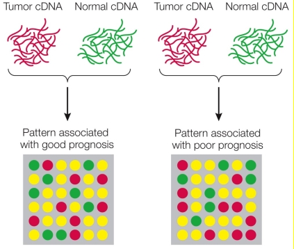 Refer to the figure showing the steps used in microarray analysis to detect differences in expression between tumor tissue and normal tissue.The spots in the bottom panel represent individual genes for patients who have good prognoses (left) as well as for patients who have poor ones (right).The colors of those spots represent levels of expression: red = high expression, yellow = intermediate expression, green = low expression.   Look at the lowest, left-most gene in both patterns.Does expression of this gene correlate with the prognoses? Explain your answer.