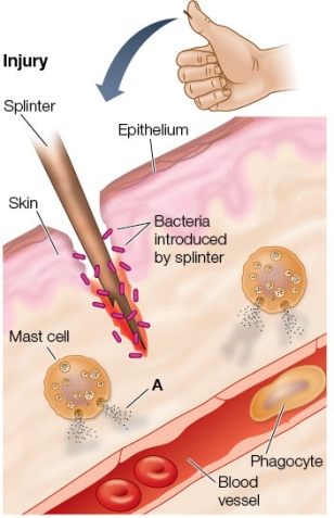 Refer to the figure showing the body's reaction to a splinter.Once the substance labeled A is released, which will be the next event in the inflammatory response?   A)  The complement proteins labeled A will induce phagocytes to leave the blood vessel. B)  The histamines labeled A will cause the blood vessel in the area to dilate and become leaky. C)  The growth factors labeled A will cause cell division in the skin for healing. D)  The lysozyme labeled A will lyse the bacteria in the wound. E)  The interferon labeled A will cause macrophages in the area to kill the bacteria.