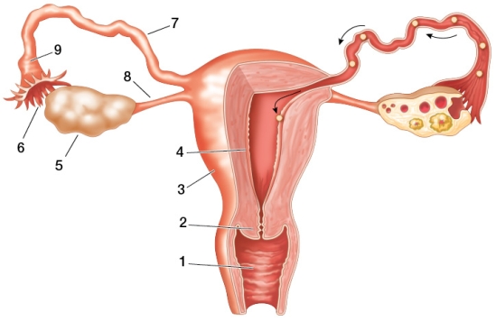 Refer to the figure showing the human female reproductive system.   Based on the figure, which statement is true? A)  The structure at point 1 is covered by a diaphragm, placed immediately below it, as a form of birth control. B)  The structure at point 8 is tied off during female sterilization. C)  Progesterone receptors in the structure at point 4 are blocked by Mifepristone (RU-486) . D)  Spermicidal jelly is applied to the structure at point 4. E)  The cycle of the structure at point 3 is stopped by combination estrogen and progesterone birth control pills.