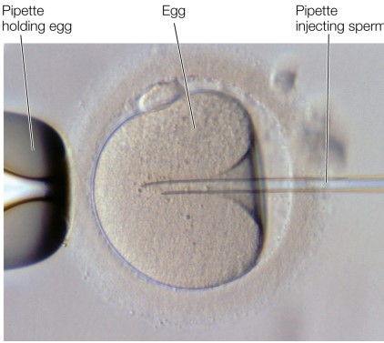 Refer to the figure showing ICSI.   What is a specific defect that would warrant using this form of assisted reproductive technology?