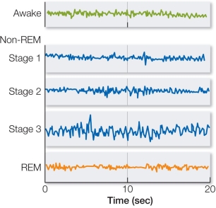 <strong>Refer to the figure. The figure shows electroencephalogram (EEG) recordings from a person who is awake and in different stages of sleep.Which of the following explains why EEG recordings show similar patterns when a person is awake and in REM sleep?</strong> A) At least some brainstem nuclei are active in both phases. B) Synchronized bursts of action potentials occur over broad areas of cortex during both phases. C) Eye movements are similar in both phases. D) The amounts of time that humans spend awake and in REM sleep are similar. E) Activity of motor pathways is the same in both phases.