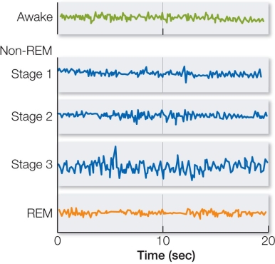 Refer to the figure below.The electroencephalogram (EEG)  recordings for Awake and REM sleep are similar because   A)  slow wave patterns occur in both states. B)  several nuclei in the reticular-activating system in the brainstem are active during both states. C)  the thalamus and the cortex are inactive in both states. D)  synchronized bursts of cortical neurons characterize both states. E)  information processing is inhibited in REM sleep but not in the awake state.