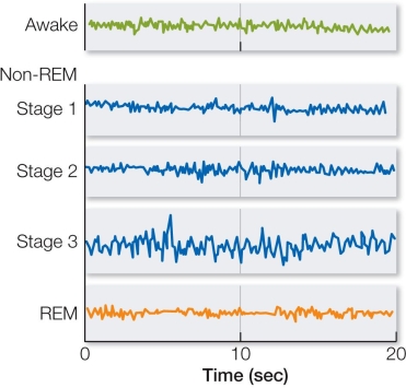 Refer to the figure below.In which of the following electroencephalogram (EEG)  recordings does deep, restorative, slow-wave sleep occur?   A)  Non-REM Stage 1 B)  Non-REM Stage 2 C)  Non-REM Stage 3 D)  REM E)  None of the recordings
