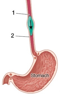 Refer to the figure showing the esophagus and stomach.   The food bolus (green)  is pushed down the esophagus because A)  longitudinal muscles are contracting at point 1 and relaxing at point 2. B)  longitudinal muscles are relaxing at point 1 and contracting at point 2. C)  circular muscles are contracting at point 1 and relaxing at point 2. D)  circular muscles are relaxing at point 1 and contracting at point 2. E)  circular muscles are relaxing at point 1 and longitudinal muscles are contracting at point 2.