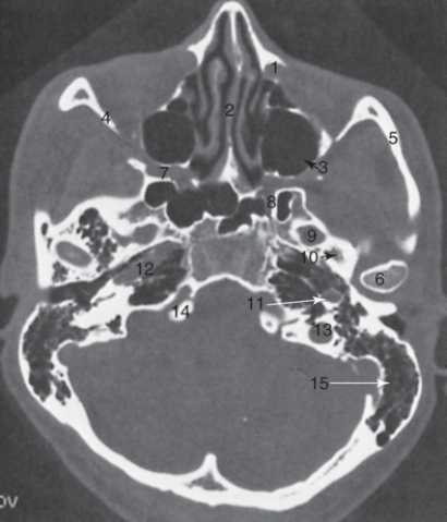 Asnwer the Questions according to the figure below:  -The structure labeled 6 is the:   A) ascending carotid canal B) lateral orbital wall C) nasal septum D) mandibular condyle