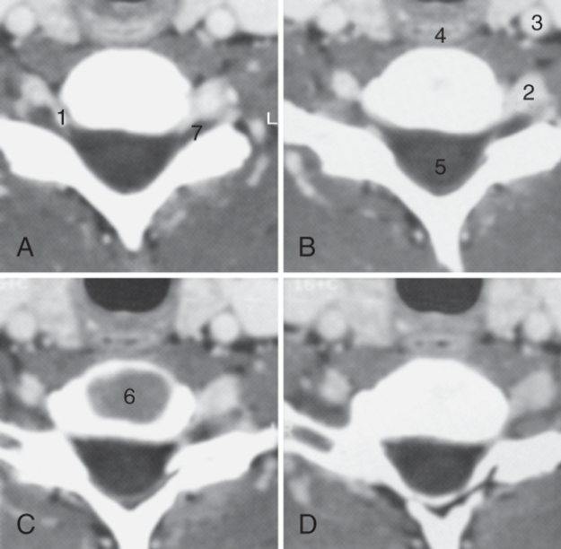 Use the following figure to answer the questions:  -The structure labeled as 4 is the:   A) carotid artery B) esophagus C) spinal cord D) vertebral artery
