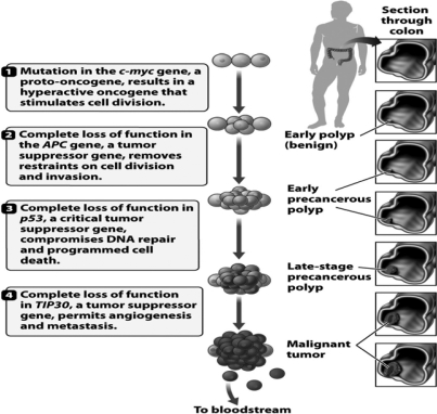 As indicated in the following diagram,in many human colon tumors,true malignancy is the result of   A)  the loss of the TIP30 tumor suppressor gene. B)  the loss of the p53 tumor suppressor gene. C)  the loss of the APC tumor suppressor gene. D)  a mutation in the c-myc gene.