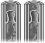 The figures shows a fragment of a clot separating and moving downstream in the venous system.When the clot encounters a vessel with a diameter smaller than itself it will become lodged and the flow of blood will be blocked.Where is this most likely to happen?   A)  in the aorta B)  in the arteries or arterioles of the lung C)  in the right atrium or right ventricle D)  in the left atrium or left ventricle