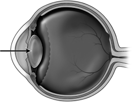 The figure below depicts a human eye.   When focusing on an object that is far away,the structure indicated by the arrow in the figure above A)  becomes flatter. B)  becomes more spherical. C)  does not change. D)  decreases in diameter.