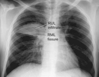 Using the figure below, what does RML stand for?   A)  right mediastinum lobe B)  right lower lobe C)  right middle lobe D)  right upper lobe E)  right middle lung