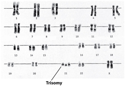 Base upon the karyotype in this question,tell what sex the individual is,if the karyotype is normal or abnormal,and if the karyotype shows an abnormality,explain what the abnormality is and what it means to the individual.