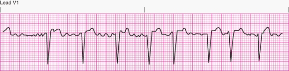 Interpret the following rhythm:   A)  Atrial Fibrillation B)  Atrial Flutter C)  Atrial flutter with RVR D)  Junctional escape rhythm