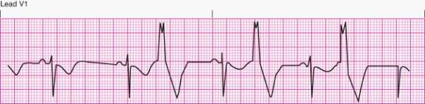 Interpret the following rhythm:   A)  Sinus rhythm with multifocal premature ventricular contractions B)  Sinus rhythm with unifocal premature ventricular contractions C)  Sinus rhythm with bigeminal premature ventricular contractions D)  Sinus rhythm with paired premature ventricular contractions (couplets) 