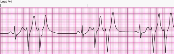 Interpret the following rhythm:   A)  Sinus rhythm with multifocal premature ventricular contractions B)  Sinus rhythm with unifocal premature ventricular contractions C)  Sinus rhythm with bigeminal premature ventricular contractions D)  Sinus rhythm with paired premature ventricular contractions (couplets) 