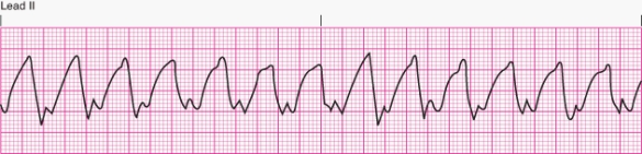 The patient is alert and talking when the nurse notices the following rhythm.The patient's blood pressure is 90/44 mm Hg.The nurse should   A)  defibrillate immediately. B)  begin basic life support. C)  begin advanced life support. D)  treat with intravenous amiodarone or lidocaine.