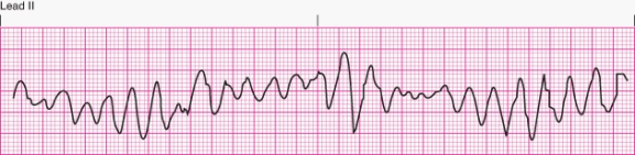 The nurse notes the following rhythm on the heart monitor.The patient is unresponsive and not breathing.The nurse should   A)  treat with intravenous amiodarone or lidocaine. B)  provide emergent basic and advanced life support. C)  provide electrical cardioversion. D)  ignore the rhythm because it is benign.