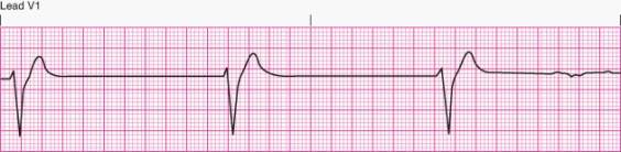 Interpret the following rhythm:   A)  Idioventricular rhythm B)  Accelerated idioventricular rhythm C)  Ventricular tachycardia D)  Ventricular fibrillation