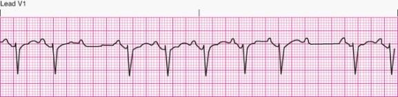 Interpret the following rhythm:   A)  First-degree AV block B)  Second-degree AV block Mobitz I (Wenckebach phenomenon)  C)  Second-degree AV block Mobitz II D)  Third-degree AV block (complete heart block) 