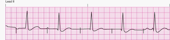 Interpret the following rhythm:   A)  Atrial pacing B)  Ventricular pacing C)  Dual-chamber pacing D)  Transcutaneous pacing