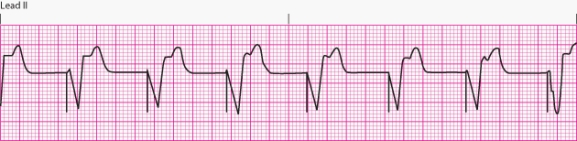 Interpret the following rhythm:   A)  Atrial pacing B)  Ventricular pacing C)  Dual-chamber pacing D)  Transcutaneous pacing