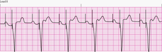 Interpret the following rhythm:   A)  Atrial pacing B)  Ventricular pacing C)  Dual-chamber pacing D)  Transcutaneous pacing