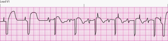 Interpret the following rhythm:   A)  Normal pacemaker function. B)  Failure to capture. C)  Failure to pace. D)  Failure to sense.