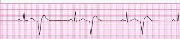 Interpret the following rhythm:   A)  Sinus rhythm with multifocal premature ventricular contractions B)  Sinus rhythm with unifocal premature ventricular contractions C)  Sinus rhythm with bigeminal premature ventricular contractions D)  Sinus rhythm with paired premature ventricular contractions (couplets) 
