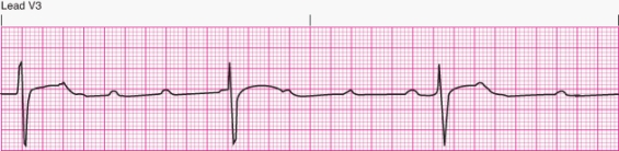 Interpret the following rhythm:   A)  First-degree AV block B)  Second-degree AV block Mobitz I (Wenckebach phenomenon)  C)  Second-degree AV block Mobitz II D)  Third-degree AV block (complete heart block) 