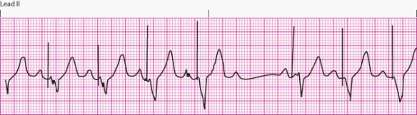 Interpret the following rhythm:   A)  Normal pacemaker function B)  Failure to capture C)  Failure to pace D)  Failure to sense