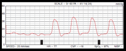 The provider prescribes a pulmonary artery occlusive pressure reading (PAOP) for a patient being monitored with a pulmonary artery catheter.Immediately after obtaining an occlusive pressure,the nurse notes the change in waveform indicated on the strip below.What are the best actions by the nurse?   Figure from Geiter H,Jr.: Swan-Ganz Catheters.http://www.nurse411.com.Accessed April 2012. A)  Turn the patient to the left side; obtain a stat portable chest x-ray. B)  Place the patient supine; repeat zero referencing of the system. C)  Document the wedge pressure; continue to monitor the patient. D)  Perform an immediate dynamic response test; obtain a chest x-ray.