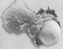   -What is occurring in thimage? A) A macrophage is engaged in phagocytosis of a foreign particle. B) A mast cell is secreting histamine. C) A T cell is engaged in phagocytosis of a foreign particle. D) An eosinophil is attacking an allergen. E) None of these are occurring.
