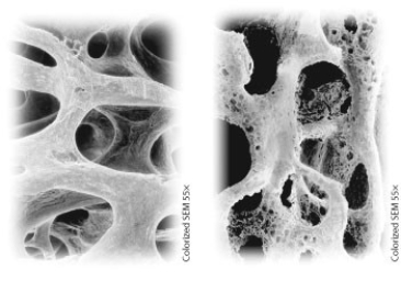 Which treatment could possibly help to transform the bone on the right to the bone on the left?   A)  wearing long sleeves while out in the sun B)  swimming for 30 minutes a day C)  removing calcium from the diet D)  taking vitamin D supplements