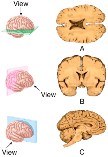 The section shown in (b) results from cutting through a _______ plane extending through the brain?   A) frontal B) sagittal C) oblique D) midsagittal E) transverse