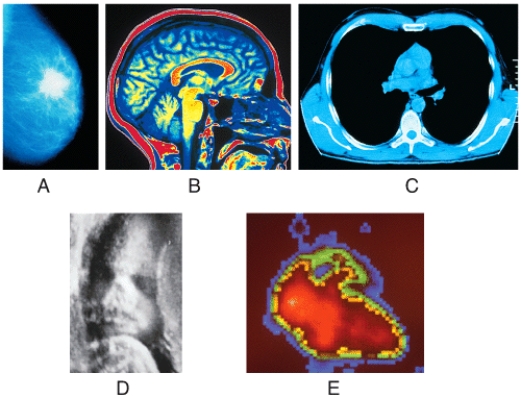 Which medical image is obtained by using a low dose of x-rays to examine soft tissues?   A) (a)  B) (b)  C) (c)  D) (d)  E) (e) 