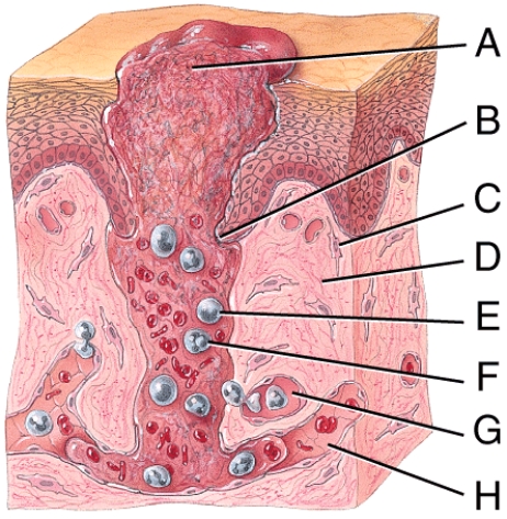 Which of the following best describes the events occurring at point A in the diagram of deep wound healing shown below?   A) Blood clot is forming. B) New collagen fibers are forming. C) Damaged blood vessels are being repaired. D) Epithelium is migrating across wound. E) Scar tissue is forming.