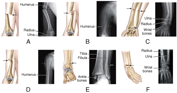 Which illustration and radiograph in the figure shows an impacted fracture where one end of the fractured bone is forcefully driven into the interior of the other end?   A) A B) B C) C D) D E) E