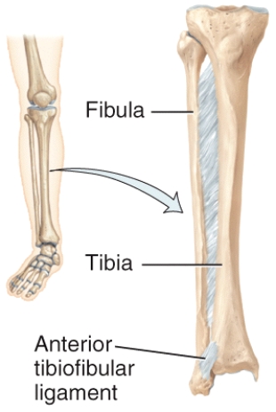 What type of joint is shown in the diagram?   A) Suture B) Syndesmosis C) Symphysis D) Cartilaginous E) Synovial