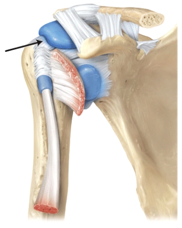 The line is pointing to the _______ ligament.   A) coracoacromial B) acromioclavicular C) glenohumeral D) coracohumeral