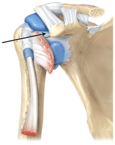 The line is pointing to the _______ ligaments.   A) coracoacromial B) acromioclavicular C) glenohumeral D) coracohumeral