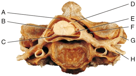 Which of the labeled structures contains cerebral spinal fluid?   A) A B) D C) E D) F E) All of these choices