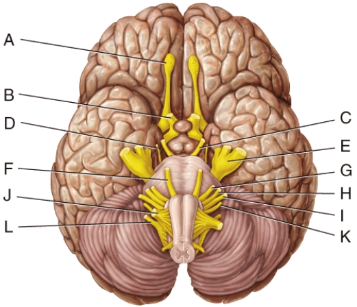 Damage to a branch of which cranial nerve in the diagram causes tinnitus?   A) E B) G C) H D) I E) J