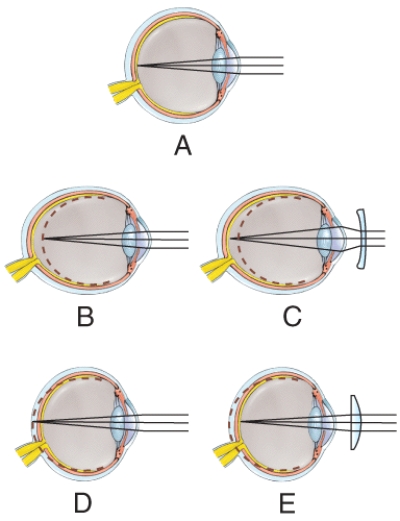 Which figure illustrates nearsightedness before it has been corrected?   A) A B) B C) C D) D E) E